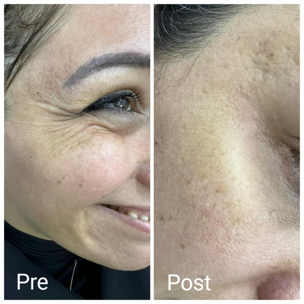 The result of Botox removing forehead wrinkles before and after